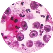 헤르페스 (Herpes Simplex Virus I & II)